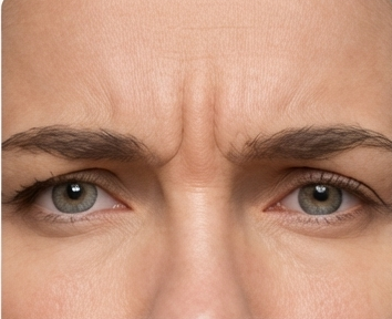 Glabella/Frown line
