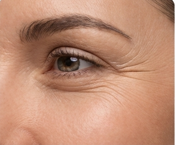 Crow's feet/Outer corner of the eye